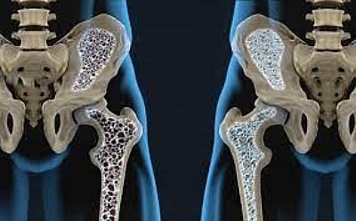 Osteoporose começa na adolescência, melhor previnir